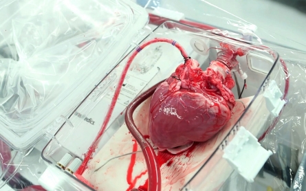 TransMedics keeps donor hearts beating en route to transplant patients